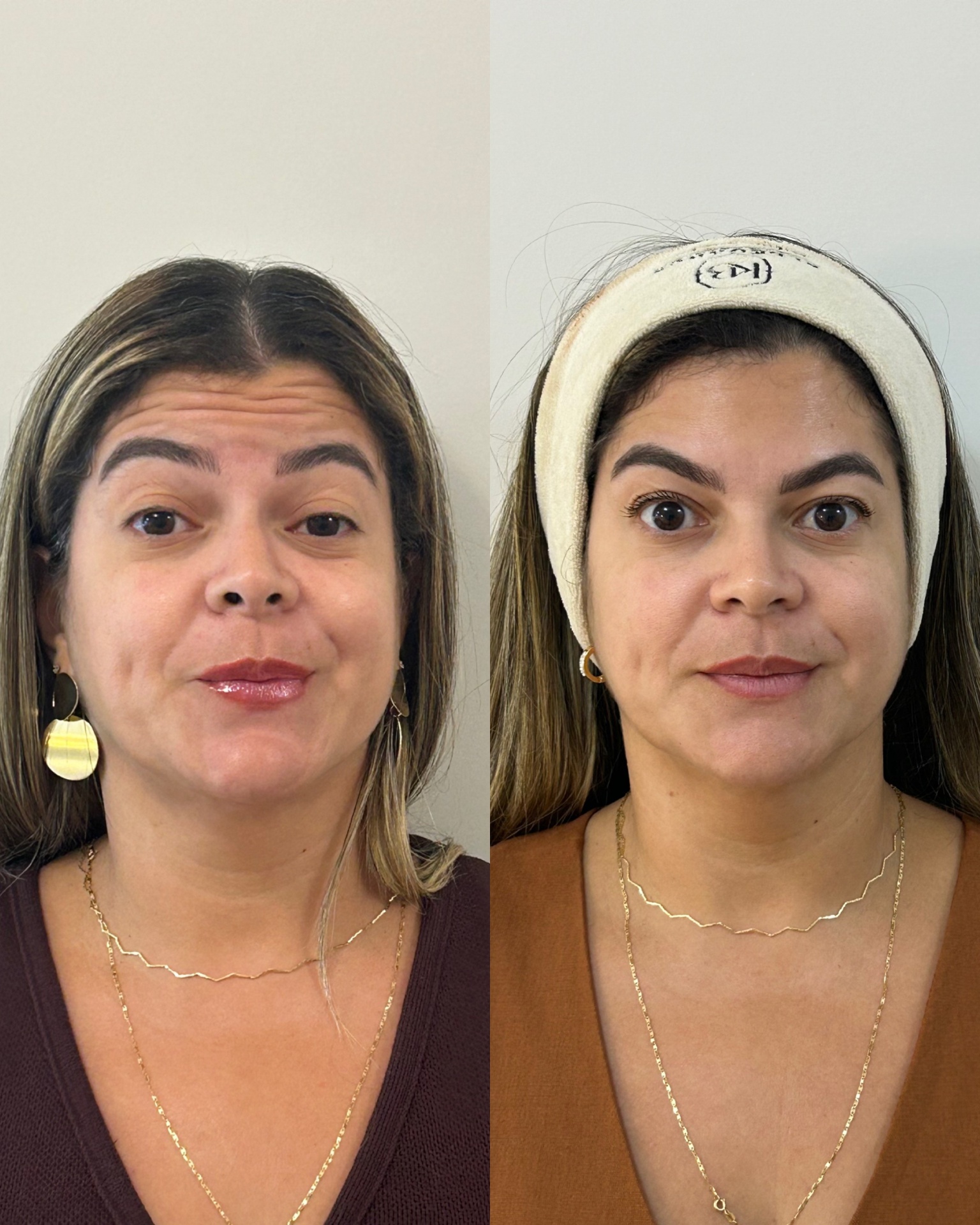 Resultado antes e depois — paciente 04